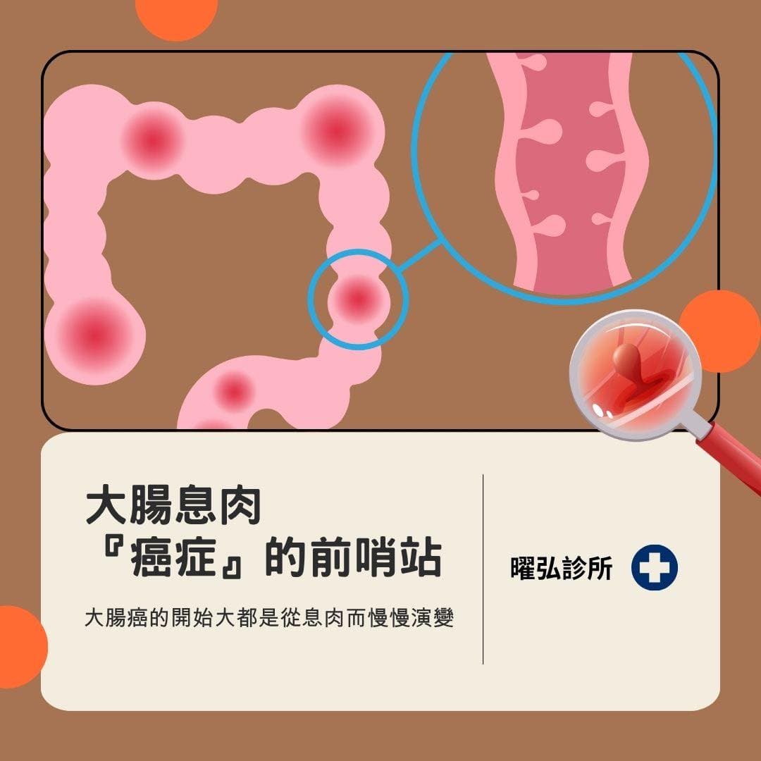 大腸息肉 —🥊 癌症的前哨站 🥊